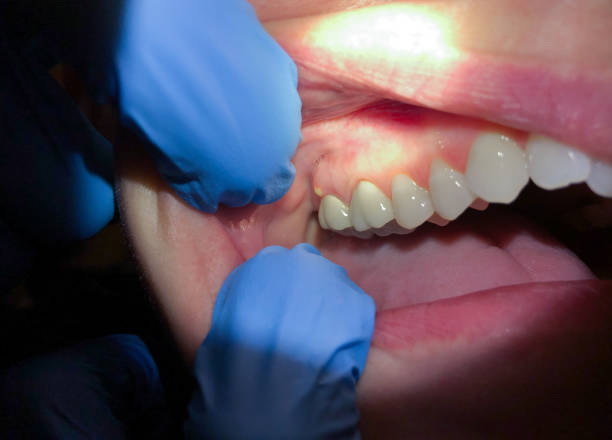 Best Emergency Wisdom Tooth Extraction in Alamo Heights, TX